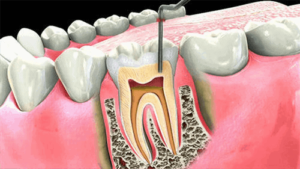 Process of the Root Canal
