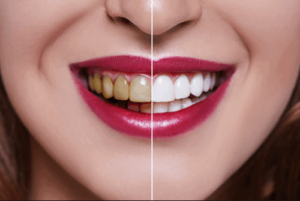 Different Types of Teeth Whitening Treatments