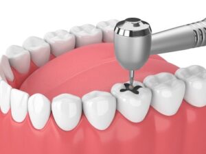 Dental-Implant-Treatment